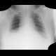 Hypoventilation, atelectasis of lower lung lobe: X-ray - Plain radiograph